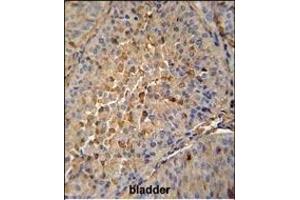 PRE1 antibody (N-term) (ABIN652240 and ABIN2841004) immunohistochemistry analysis in forlin fixed and paraffin embedded hun bladder carcino followed by peroxidase conjugation of the secondary antibody and DAB staining. (MAPRE1 antibody  (N-Term))