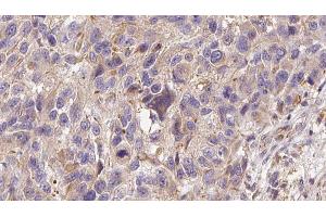 ABIN6273000 at 1/100 staining Human Melanoma tissue by IHC-P. (Glutathione Peroxidase 7 antibody  (Internal Region))