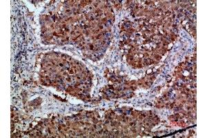 Immunohistochemical analysis of paraffin-embedded human-lung-cancer, antibody was diluted at 1:200 (Integrin alpha 1 antibody  (AA 920-980))