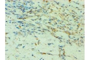 Immunohistochemistry of paraffin-embedded human breast cancer using ABIN7155523 at dilution of 1:100 (SMYD3 antibody  (AA 199-428))