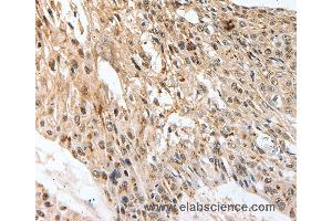 Immunohistochemistry of Human esophagus cancer using SLC1A7 Polyclonal Antibody at dilution of 1:60 (SLC1A7 antibody)