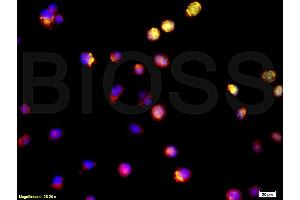 Formalin-fixed human oral squamous cell carcinoma labeled with Anti-Survivin Polyclonal Antibody, Cy3 conjugated (ABIN670911) used at 1:200 dilution for 40 minutes at 37°C, followed by DAPI staining (Survivin antibody  (AA 85-142))