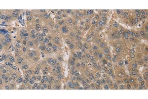 Immunohistochemistry of paraffin-embedded Human liver cancer using DPYSL3 Polyclonal Antibody at dilution of 1:30 (DPYSL3 antibody)