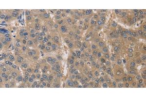 Immunohistochemistry of paraffin-embedded Human liver cancer using DPYSL3 Polyclonal Antibody at dilution of 1:30