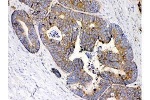 MPS1 was detected in paraffin-embedded sections of human intetsinal cancer tissues using rabbit anti- MPS1 Antigen Affinity purified polyclonal antibody (Catalog # ) at 1 ?