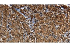 Immunohistochemistry of paraffin-embedded Human thyroid cancer using GLO1 Polyclonal Antibody at dilution of 1:50 (GLO1 antibody)