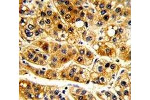 IHC analysis of FFPE human hepatocarcinoma with IkB alpha antibody (NFKBIA antibody  (AA 12-41))