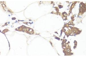 Immunohistochemistry of paraffin-embedded Human breast cancer using SMAD7 Polyclonal Antibody at dilution of 1:100 (40x lens). (SMAD7 antibody)