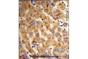 Formalin-fixed and paraffin-embedded human hepatocarcinoma reacted with HYOU1 Antibody , which was peroxidase-conjugated to the secondary antibody, followed by DAB staining. (HYOU1 antibody  (AA 274-303))
