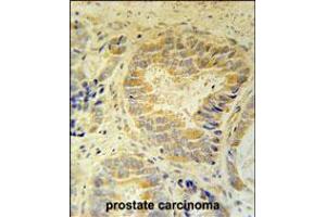 FAM105B Antibody immunohistochemistry analysis in formalin fixed and paraffin embedded human prostate carcinoma followed by peroxidase conjugation of the secondary antibody and DAB staining. (FAM105B antibody  (AA 99-128))