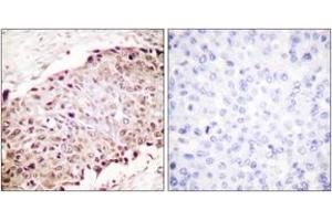 Immunohistochemistry analysis of paraffin-embedded human breast carcinoma tissue, using Sumo1 Antibody. (SUMO1 antibody  (AA 1-50))