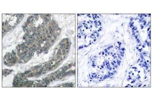 Immunohistochemical analysis of paraffin-embedded human breast carcinoma tissue using p62Dok (Ab-398) antibody (E021269). (DOK1 antibody)