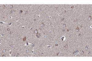 ABIN6276904 at 1/100 staining Human brain cancer tissue by IHC-P. (Glutamate Receptor 1 antibody  (C-Term))