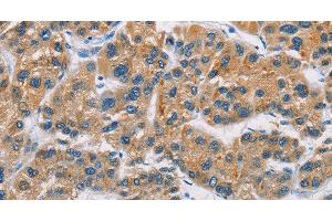 Immunohistochemistry of paraffin-embedded Human liver cancer tissue using CERK Polyclonal Antibody at dilution 1:30 (CERK antibody)