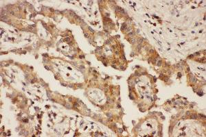 Anti-CXCR3 Picoband antibody,  IHC(P): Human Lung Cancer Tissue (CXCR3 antibody  (AA 1-368))