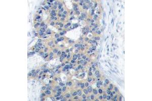 Immunohistochemistry of paraffin-embedded human breast carcinoma using Phospho-STMN1-S38 antibody (ABIN2987644). (Stathmin 1 antibody  (pSer38))
