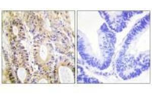 Immunohistochemistry analysis of paraffin-embedded human colon colon tissue using Smad3 (Ab-204) antibody. (SMAD3 antibody  (Ser204))