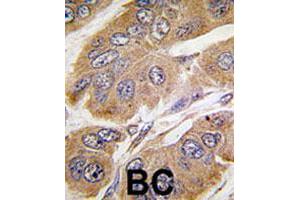 Formalin-fixed and paraffin-embedded human breast cancer tissue reacted with RPS6KB1 polyclonal antibody  , which was peroxidase-conjugated to the secondary antibody, followed by DAB staining. (RPS6KB1 antibody  (Ser424))