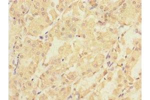 Immunohistochemistry of paraffin-embedded human gastric cancer using ABIN7163386 at dilution of 1:100 (PMM2 antibody  (AA 1-246))