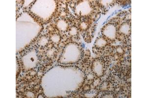 Immunohistochemistry of Human thyroid cancer using S100A1 Polyclonal Antibody at dilution of 1:70 (S100A1 antibody)