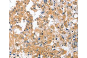 Immunohistochemistry (IHC) image for anti-Cerebellar Degeneration-Related Protein 2, 62kDa (CDR2) antibody (ABIN2423131) (CDR2 antibody)