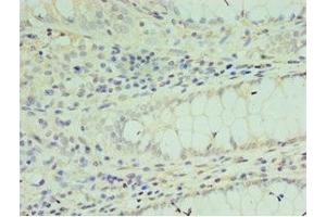 Immunohistochemistry of paraffin-embedded human colon cancer using ABIN7172637 at dilution of 1:100
