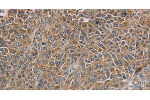 Immunohistochemistry of paraffin-embedded Human ovarian cancer tissue using NDUFS7 Polyclonal Antibody at dilution 1:40 (NDUFS7 antibody)