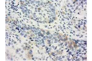 Immunohistochemical staining of paraffin-embedded Carcinoma of Human bladder tissue using anti-LIN7B mouse monoclonal antibody. (LIN7B antibody)