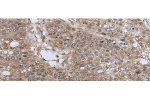 Immunohistochemistry of paraffin-embedded Human liver cancer tissue using UBE4B Polyclonal Antibody at dilution of 1:40(x200) (UBE4B antibody)