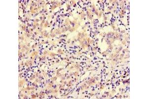 Immunohistochemistry of paraffin-embedded human lung cancer using ABIN7171083 at dilution of 1:100 (SMARCE1 antibody  (AA 20-243))