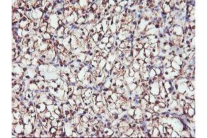 Immunohistochemical staining of paraffin-embedded Carcinoma of Human kidney tissue using anti-SERPINB6 mouse monoclonal antibody. (SERPINB6 antibody)