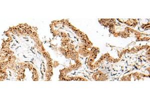 Immunohistochemistry of paraffin-embedded Human thyroid cancer tissue using FAM84B Polyclonal Antibody at dilution of 1:70(x200) (FAM84B antibody)
