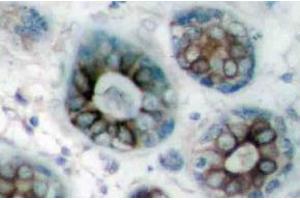 Immunohistochemistry (IHC) analyzes of GAP43 antibody in paraffin-embedded human breast carcinoma tissue. (GAP43 antibody)