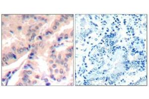 Immunohistochemical analysis of paraffin-embedded human lung carcinomatissue using eIF4B(Phospho-Ser422) Antibody(left) or the same antibody preincubated with blocking peptide(right). (EIF4B antibody  (pSer422))