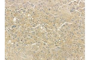 ABIN6260133 and ABIN6273197 at 1/100 staining human hepatocellular carcinoma by IHC-P.