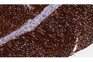 ABIN6276368 at 1/100 staining Human urothelial cancer tissue by IHC-P. (CD40 Ligand antibody  (Internal Region))