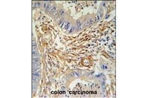 PRB2 Antibody (C-term) (ABIN6244055 and ABIN6578967) immunohistochemistry analysis in formalin fixed and paraffin embedded human colon carcinoma followed by peroxidase conjugation of the secondary antibody and DAB staining. (PRB2 antibody  (C-Term))