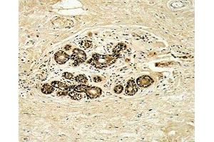 IHC analysis of FFPE human breast carcinoma with HER3 antibody (ERBB3 antibody  (AA 24-55))