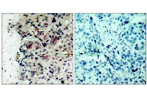 Immunohistochemical analysis of paraffin-embedded human breast carcinoma tissue using JAK1 (Ab-1022) antibody (E021119). (JAK1 antibody)