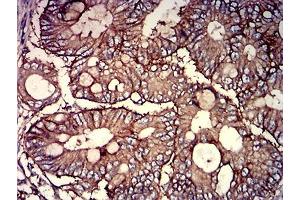 Immunohistochemical analysis of paraffin-embedded rectum cancer tissues using CD46 mouse mAb with DAB staining. (CD46 antibody  (AA 35-179))