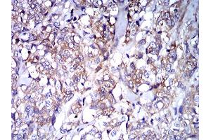 Immunohistochemical analysis of paraffin-embedded breast cancer tissues using IghA1 mouse mAb with DAB staining. (IGHA1 antibody  (AA 207-353))