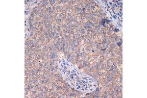 Immunohistochemistry of paraffin-embedded human breast cancer using CTNN Rabbit mAb (ABIN7266135) at dilution of 1:100 (40x lens). (CTNNA3 antibody)