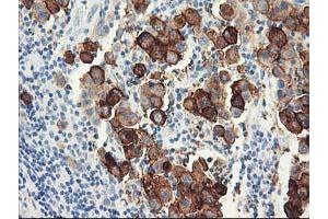 Immunohistochemical staining of paraffin-embedded Carcinoma of Human lung tissue using anti-DPP10 mouse monoclonal antibody.