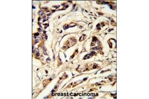 Formalin-fixed and paraffin-embedded human breast carcinoma reacted with TSHB Antibody (Center), which was peroxidase-conjugated to the secondary antibody, followed by DAB staining.