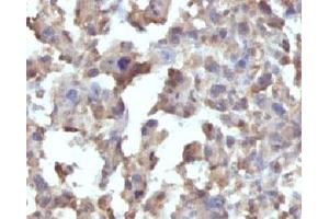 Formalin-fixed, paraffin-embedded human Histiocytoma stained with TNF alpha antibody (TNFA/1172) (TNF alpha antibody)