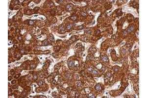 IHC-P Image Immunohistochemical analysis of paraffin-embedded human hepatoma, using LSS, antibody at 1:500 dilution.