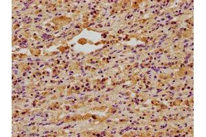IHC image of ABIN7150498 diluted at 1:400 and staining in paraffin-embedded human lung cancer performed on a Leica BondTM system. (DNAJA3 antibody  (AA 86-184))