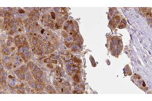 ABIN6277401 at 1/100 staining Human liver cancer tissue by IHC-P. (SLC16A1 antibody  (Internal Region))