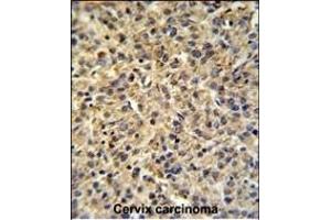 TPRGL Antibody (N-term) (ABIN651274 and ABIN2840164) IHC analysis in formalin fixed and paraffin embedded human cervix carcinoma tissue followed by peroxidase conjugation of the secondary antibody and DAB staining. (TPRG1L antibody  (N-Term))