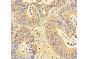 Immunohistochemistry of paraffin-embedded human colon cancer using ABIN7150594 at dilution of 1:100 (RPN1 antibody  (AA 44-427))